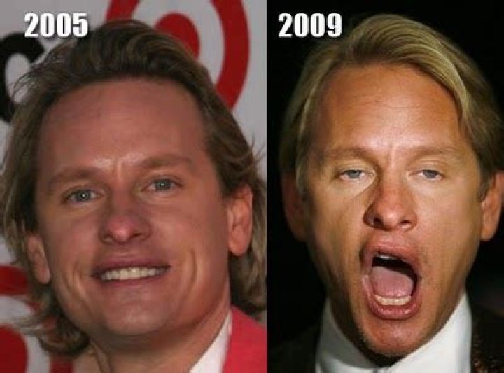 
What Did Carson Kressley Look Like Before And After Plastic Surgery? 